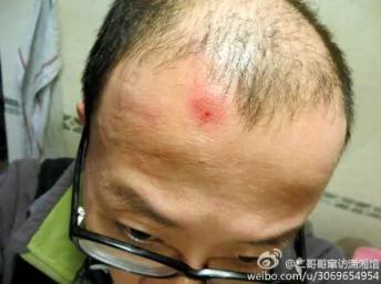 胡佳在社交网站推特展示被国保殴打后的伤势照片，胡佳说他的头部因撞击地面而流血，他的腰部亦有受伤。