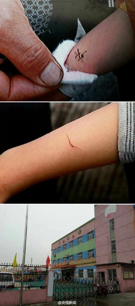 上海幼儿园老师用剪刀剪伤7名孩子手腕称惩罚坐姿不端(图)