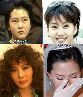 韓國整容先驅遇後遺症 女星變殘