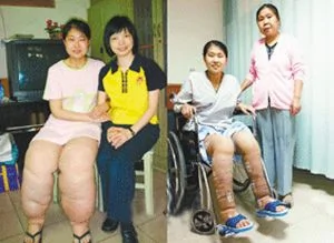 徐州“象腿”女孩赴台湾手术后 变身“俏佳人” 