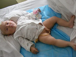 图片:肾结石婴儿小明由于不能小便，需要借助导尿管(志愿者)