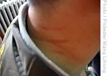 示威人士史義軍的脖頸被抓傷