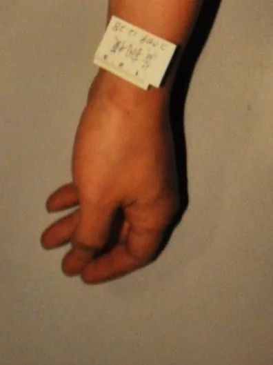 重慶李莊案進展：法院傷情鑑定,龔剛模腕部傷痕清晰可見