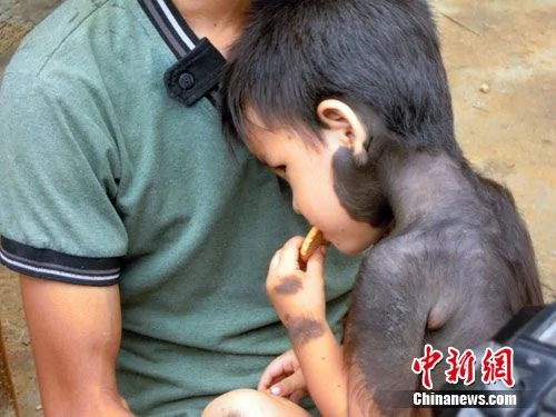 广西两岁男童浑身有长毛 剪掉后会立即发烧