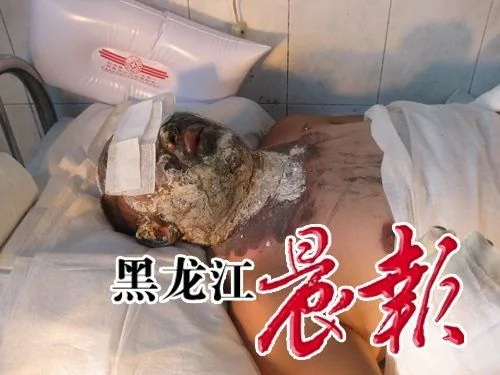 黑龙江密山市一56岁男子自焚抗议强拆/视频