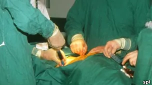 器官移植手術