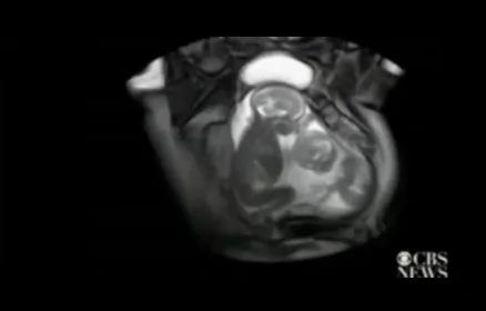 英國醫護人員掃描發現雙胞胎在子宮裏「掐架」(組圖)