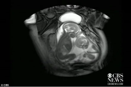英國醫護人員掃描發現雙胞胎在子宮裏「掐架」(組圖)