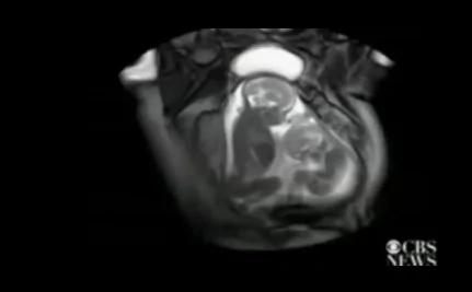 英國醫護人員掃描發現雙胞胎在子宮裡「掐架」(組圖)