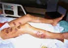 7/30/2001發表.法輪功學員覃永潔被中國警察用燒紅的鐵條烙傷十三處