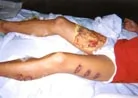 7/30/2001发表.法轮功学员覃永洁被中国警察用烧红的铁条烙伤十三处