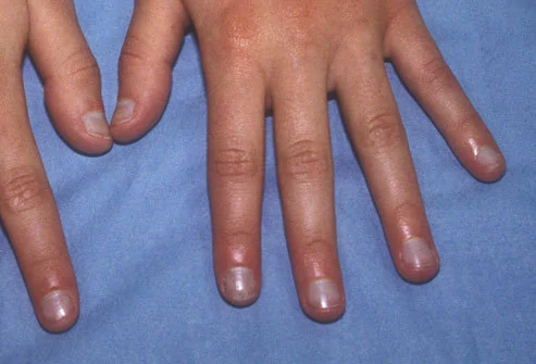 指甲看出身体哪有疾病