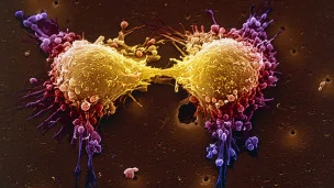 醋用新方——成功檢測子宮頸癌
