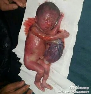 中國再曝7月胎兒被引產事件