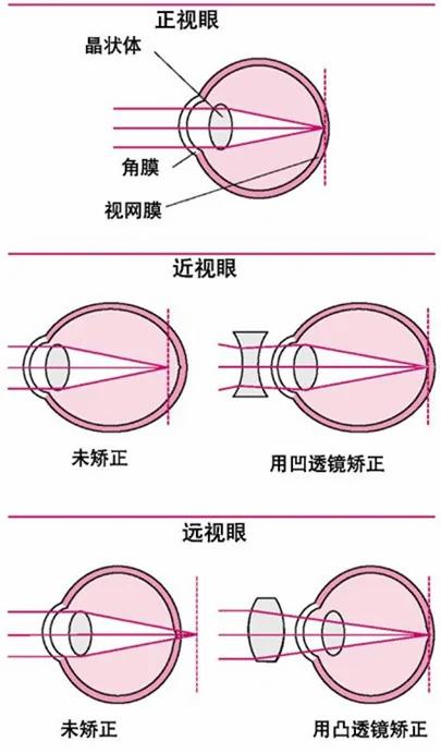 真正根治高度近视眼 坚持三年 即使800度近视也可以根治