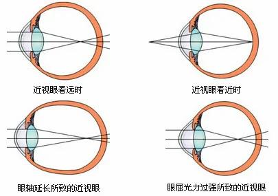 真正根治高度近视眼 坚持三年 即使800度近视也可以根治