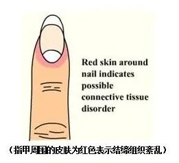 指甲出现这十种可怕现象 需要马上求医
