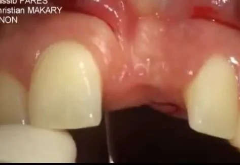 资深牙医良心告白：能做假牙就别植牙！