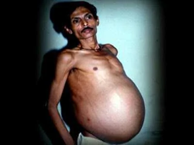 印度奇男子怀胎36年剖腹产下同胞兄弟