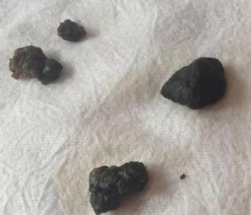 动手清理你的结石,救你自己的命 !