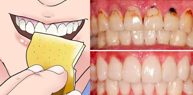 不用洗牙 六个方法就能去除牙菌斑 再也不怕洗牙痛痛了 阿波罗新闻网