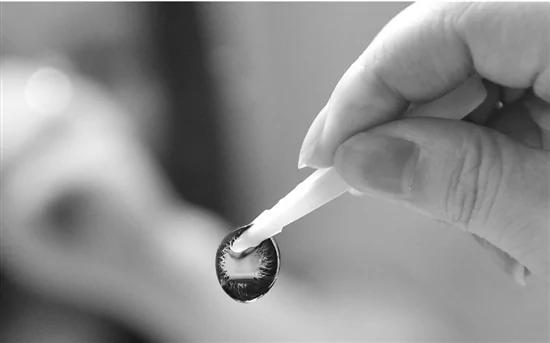 女子网购美瞳戴一个月 眼皮里长出十几颗结石