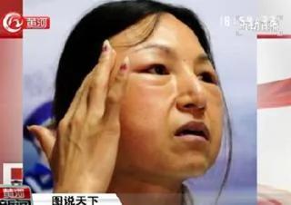 17岁女孩为变旺夫脸斥巨资整容 变成老太婆