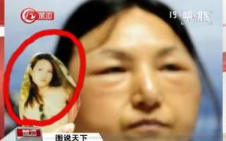 17岁女孩为变旺夫脸斥巨资整容 变成老太婆