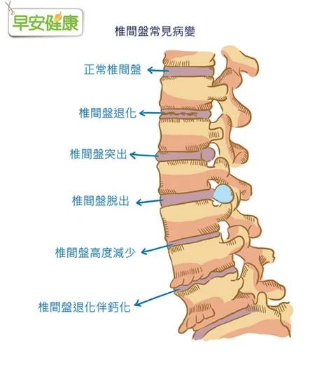 什么!骨松 腰痛 关节炎不只是因姿势不良 竟是因为...