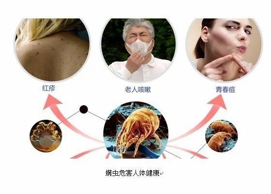 太可怕了!4岁小孩无故掉发长满红疹原因居然只是尘蟎!医生都吓到了!