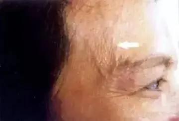 青筋凸起:痰 湿 瘀 毒积滞 不可不防