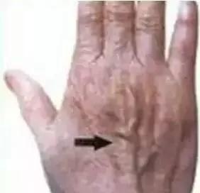 青筋凸起:痰 湿 瘀 毒积滞 不可不防