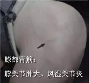 青筋凸起:痰 湿 瘀 毒积滞 不可不防