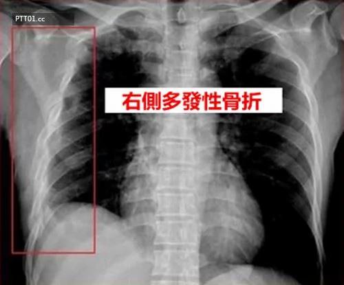 打喷嚏竟然喷断自己的肋骨,教你轻松打不怕伤到身体