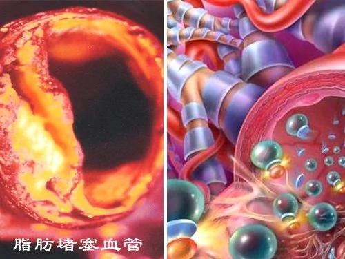 血管是如何一天天堵塞的,看完吓一跳