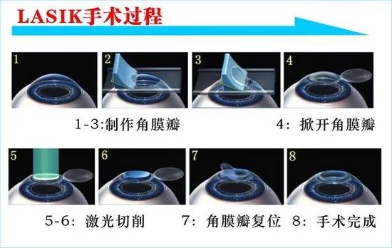 医生不说的真相 近视手术风险令你生不如死 视频