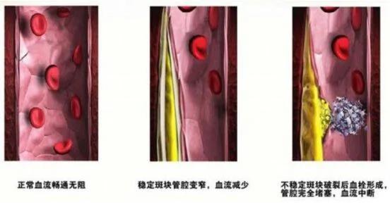 血管是否被堵塞,只要摸摸“这里”就知道!