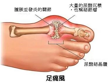 原来洗肾前会有这12种警讯 快看看吧!