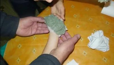 四岁儿子手掌严重烫伤,爸妈用这个10分钟就将死皮脱下来了