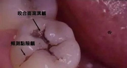 牙齿出现小黑点 千万别忽视它可怕的力量!