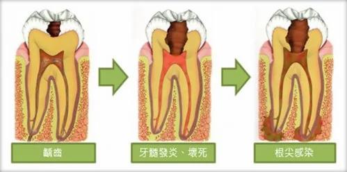 牙齿出现小黑点 千万别忽视它可怕的力量!