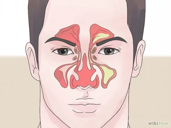 Get Rid of a Stuffy Nose Quickly Step15