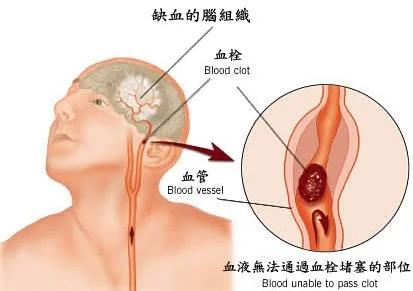 大陆脑梗塞复发率高达40%,如何防治?