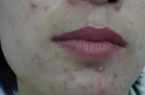 一定没有人告诉你:这种“痘痘”一定要挤