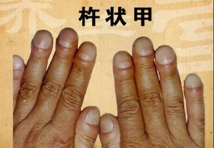 藏在指甲里的10个健康警讯