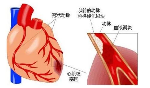 心梗突发或心脏不适,这么做,太有救了!