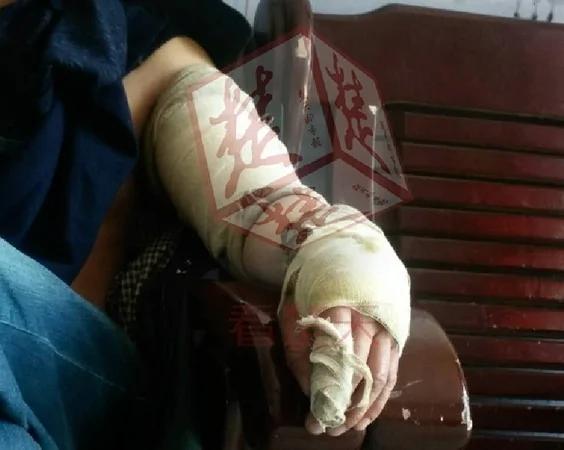 眼镜蛇“断头”飞10公分报仇 食指被咬整条手肿成火腿