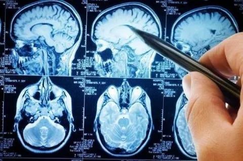 最新研究:添加糖伤害大脑基因!诱发抑郁痴呆