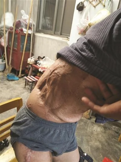 南京男子2年前捡到“铱链”受辐射落下终身残疾
