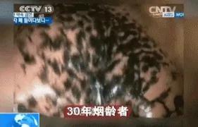 吓人!30年烟龄者的肺黑成这样,看了你还敢吸烟吗?